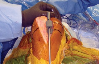 Illustration 27 for Minimize Pain, Maximize Recovery: TKA with Parapatellar