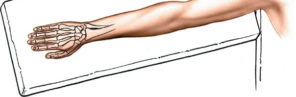 Illustration 3 for Essential Surgical Approaches: Uncover Every Aspect of the Wrist
