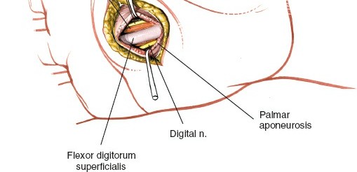 Image demonstrating entry into the medial midpalmar space