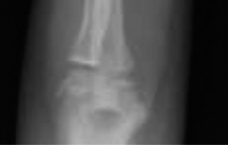 Illustration 6 for Pediatric Orthopedic Cases: Diagnose & Treat a Child's Wrist Fracture