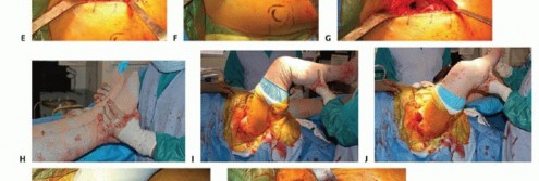 صورة طبية: نصف مفصل الورك: دليلك الشامل لدواعي الاستخدام والأنواع في صنعاء