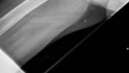 Illustration 4 for Hybrid Primary Total Hip: A Solution for Complex Joint Pain