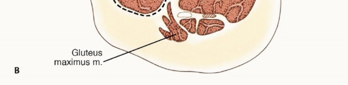 صورة طبية: استئصال ساركوما العضلة الرباعية مع الحفاظ على الطرف: دليل شامل للمرضى مع الأستاذ الدكتور محمد هطيف في صنعاء