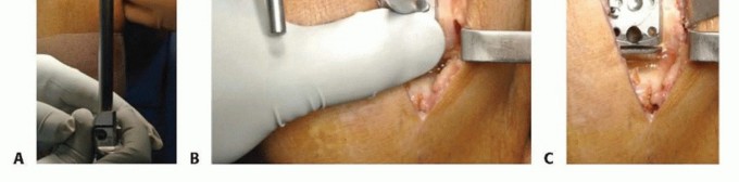 Illustration 10 for Unicondylar Knee Arthroplasty: Is This Your Solution to Knee Pain?