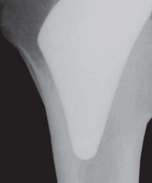 The Proxima: Why This Proximally Loading Implant Preserves Bone