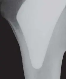 صورة توضيحية لـ مفصل بروكسيما للورك: ثورة في الحفاظ على العظم واستبدال مفصل الورك