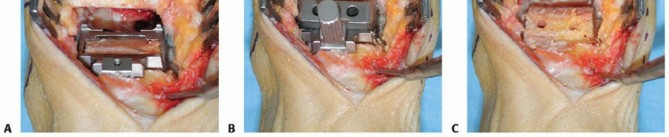 Illustration 22 for HINTEGRA Total Ankle: Unlocking Natural Ankle Movement