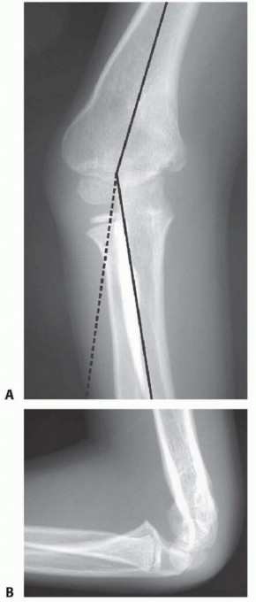 Is Supracondylar Humeral Osteotomy Right for Cubitus Varus?