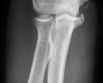 Illustration 2 for Solve Orthopedic Cases: Extensor Carpi Radialis Brevis & Elbow Pain