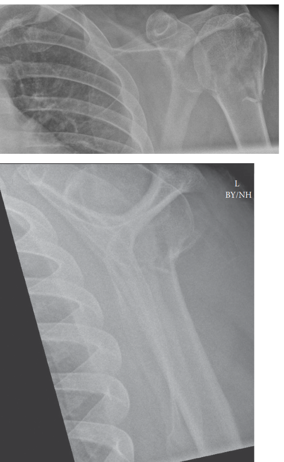 Managing a Humerus Fracture Proximal? Expert Care & Recovery