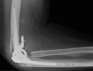 Illustration 84 for Right Shoulder Pain? Avoid This Common X-ray Mistake.