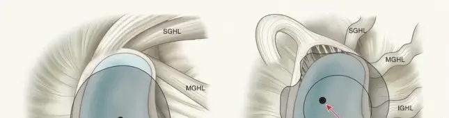 صورة توضيحية لـ كتف الرامي: فهم شامل، أسباب، أعراض، وعلاجات متقدمة لعودة الرياضيين بقوة