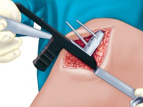 Illustration 60 for Knee Arthroplasty: Avoiding Pitfalls & Benefiting from UKA