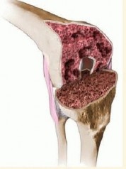 Femoral Bone Loss: Metal Augments for Revision Knee Success