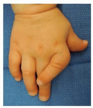 Is Clinodactyly Surgical Treatment Right for You?