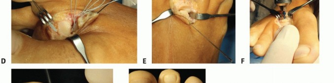 Illustration 42 for Plantar Plate Repair: End Lesser Toe Pain & Instability