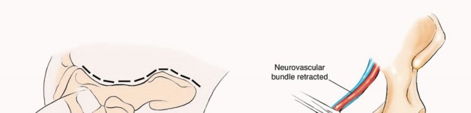 توضيح طبي: جراحة نقائل الحوض: حل شامل لآلام العظام واستعادة الحركة مع الأستاذ الدكتور محمد هطيف