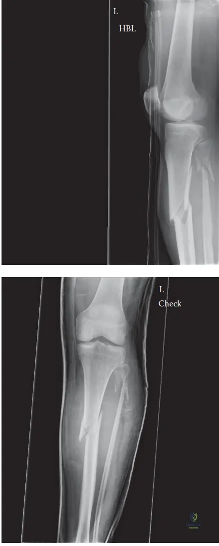 Illustration of fracture proximal answe - Dr. Mohammed Hutaif