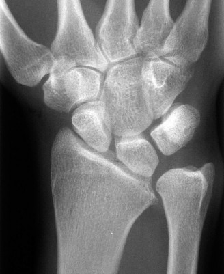 Illustration 14 for Christine M Kleinert Discussion: Solving Difficult Wrist Fractures