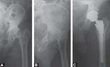 Maximize Success: Preoperative planning in primary Hip Replacement