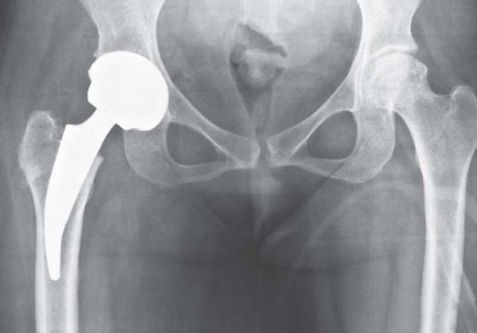 صورة طبية: مفصل الفخذ الصناعي قصير الجذع METHA: حلول مبتكرة للحفاظ على العظم في صنعاء مع الأستاذ الدكتور محمد هطيف