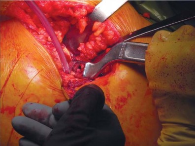 صورة طبية: تقنية الجذع القصير لاستبدال مفصل الورك الكلي: نهج الأستاذ الدكتور محمد هطيف لتدخل جراحي أقل ونتائج أفضل