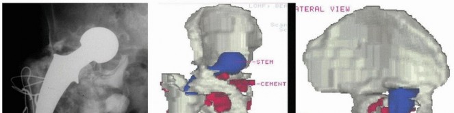 Custom Triflanged Devices: Solving Massive Acetabular Bone Loss