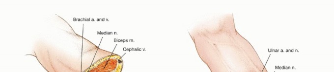 صورة توضيحية لـ بتر الذراع فوق وتحت الكوع: متى ولماذا يصبح ضرورة طبية؟ دليل شامل من الأستاذ الدكتور محمد هطيف