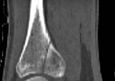 Illustration 20 for Tibial Fracture Extending into the Plafond: Intramedullary Secrets