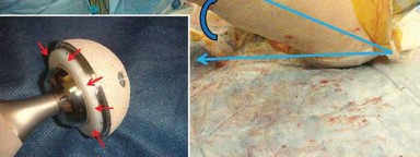 Illustration 17 for Mastering Soft Tissue Balancing for Optimal THR Outcomes