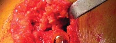 صورة طبية: تقنية الجذع القصير لاستبدال مفصل الورك الكلي: نهج الأستاذ الدكتور محمد هطيف لتدخل جراحي أقل ونتائج أفضل