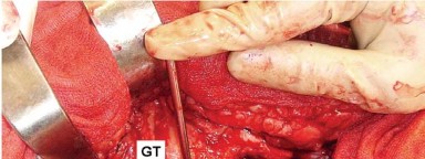 Illustration 4 for Mastering Soft Tissue Balancing for Optimal THR Outcomes