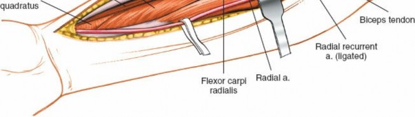 Illustration 12 for Mastering Approaches to the Upper Third of the Radius