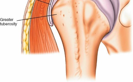 Illustration 7 for Step-by-Step Guide: Minimally Invasive Approach to the Proximal Humerus