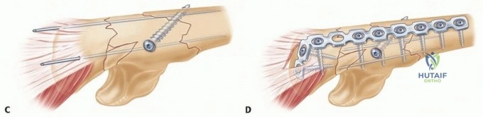 Illustration of fixation of monteggia fractures - Dr. Mohammed Hutaif
