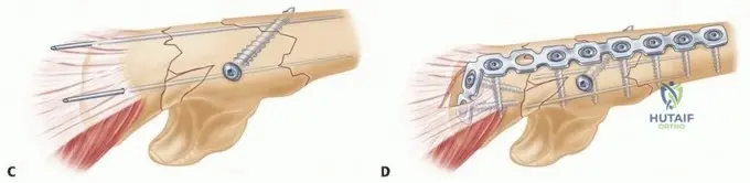 Illustration of fixation of monteggia fractures - Dr. Mohammed Hutaif