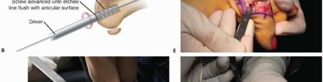 Illustration 24 for End Articular Cartilage Loss: Arthrosurface HemiCAP Resurfacing