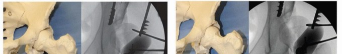 Illustration 10 for Periacetabular Osteotomy: Realigning your hip via the superior pubic ramus