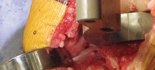 Illustration 24 for Posterior Stabilized Technique: Essential Insights for TKA Success