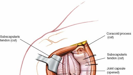 Illustration 35 for Essential Guide: Mastering Every Approach to the Shoulder