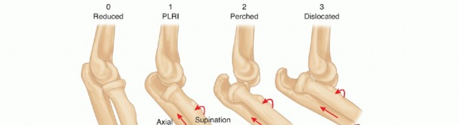 Beyond Reduction: Simple Elbow Dislocation Repair & Reconstruction