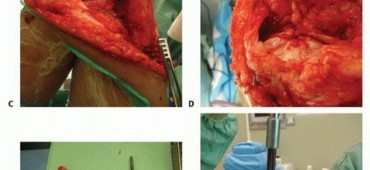 صورة توضيحية لـ الأطراف الصناعية القابلة للتمدد للأطفال: دليل شامل للمرضى حول الوقاية من العدوى والعلاج في صنعاء مع الأستاذ الدكتور محمد هطيف