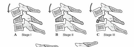 C3-C7 Cervical Spine Injuries: Recognize, Diagnose, Treat