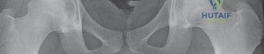 Fixation of the Greater Trochanter