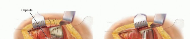 صورة طبية: نصف مفصل الورك: دليلك الشامل لدواعي الاستخدام والأنواع في صنعاء