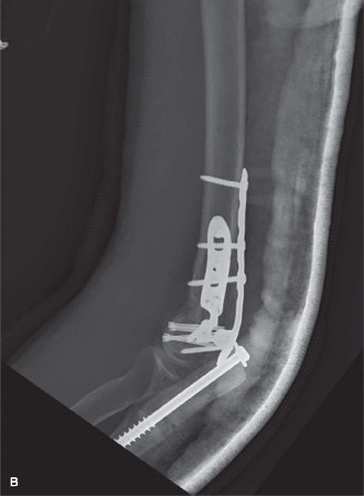 Illustration 6 for Mastering Distal Humerus Fractures: Diagnosis & Treatment
