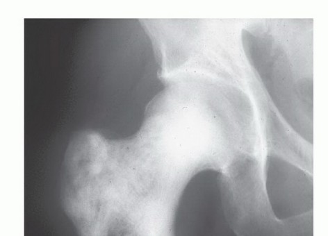 Illustration 20 for Plain Radiograph Showing MBD: Surgical Planning to Prevent Failures