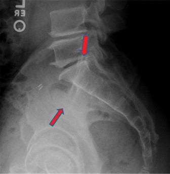 Pelvic Ring Injuries: Understanding APC II Management