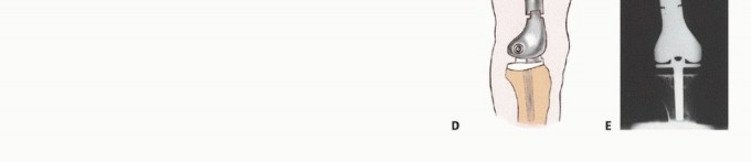 Illustration 39 for Beyond Amputation: Total Femur Resection with Endoprosthetics