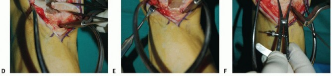 Illustration 33 for Unlock Healing: Medial Malleolar Osteotomy for Talus OLT Allografts